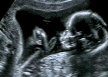 Doktori sheh një rreth të bardhë rreth kokës së foshnjës në eko dhe çuditet, por nëna e kupton të vërtetën kur lind