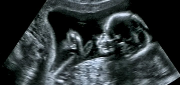 Doktori sheh një rreth të bardhë rreth kokës së foshnjës në eko dhe çuditet, por nëna e kupton të vërtetën kur lind