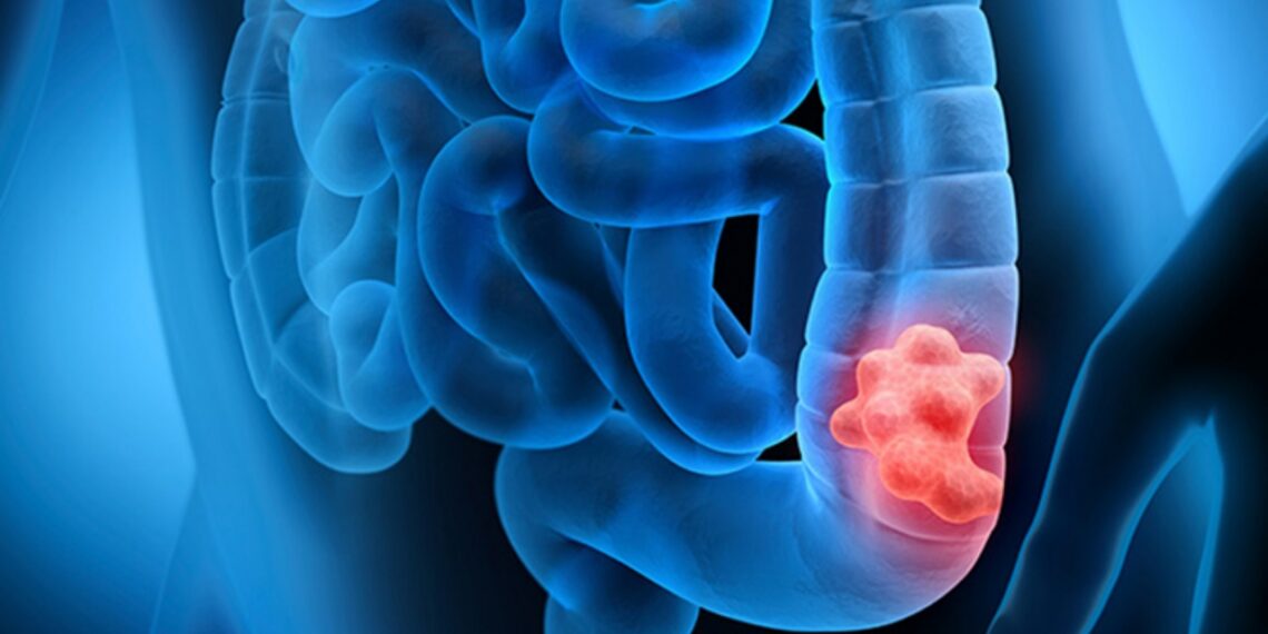 Kanceri i zorrës së trashë po përhapet me shpejtësi tek moshat e reja si pasojë e këtij gabimi