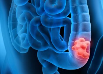 Kanceri i zorrës së trashë po përhapet me shpejtësi tek moshat e reja si pasojë e këtij gabimi