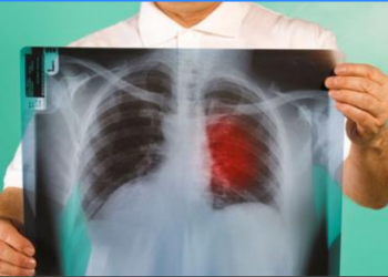 Mjeku tregon simptomat e para te kancerit të mushkërive qe nuk duhet ti injoroni