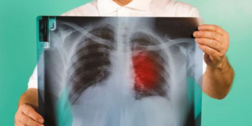 Mjeku tregon simptomat e para te kancerit të mushkërive qe nuk duhet ti injoroni