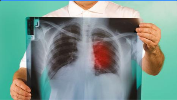 Mjeku tregon simptomat e para te kancerit të mushkërive qe nuk duhet ti injoroni