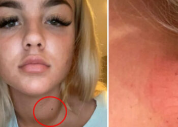 Ndihej e lodhur dhe e këputur, mjekët i thanë se nuk ke gjë, por ja cfarë zbuloi më pas 21-vjeçarja