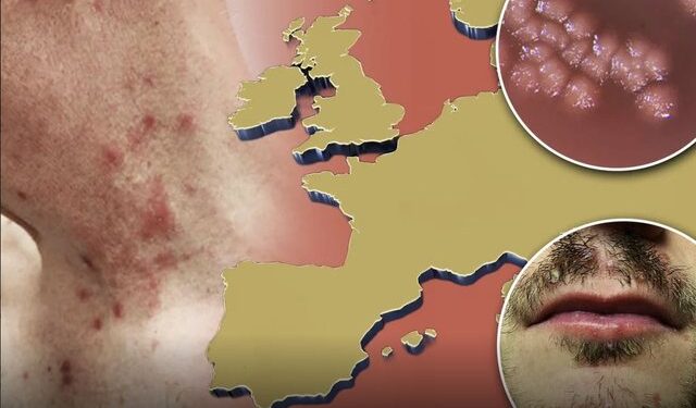 “Sëmundja e shiut” po tërheq vëmendjen në Evropë, ja çfarë u zbulua së fundmi mbi simptomat